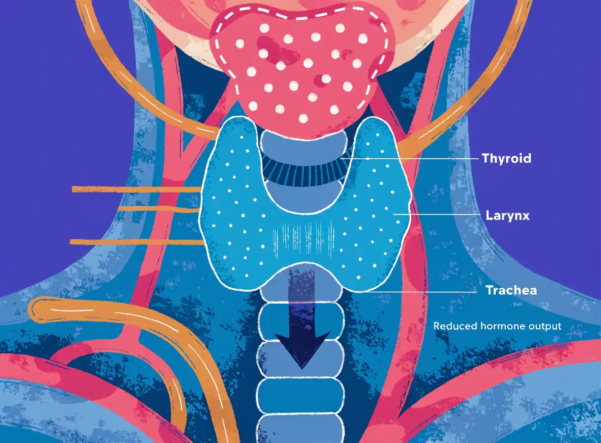 کمکاری تیروئید (Hypothyroidism)؛ علائم، تشخیص و درمان کمکاری تیروئید (Hypothyroidism)؛ علائم، تشخیص و درمان
