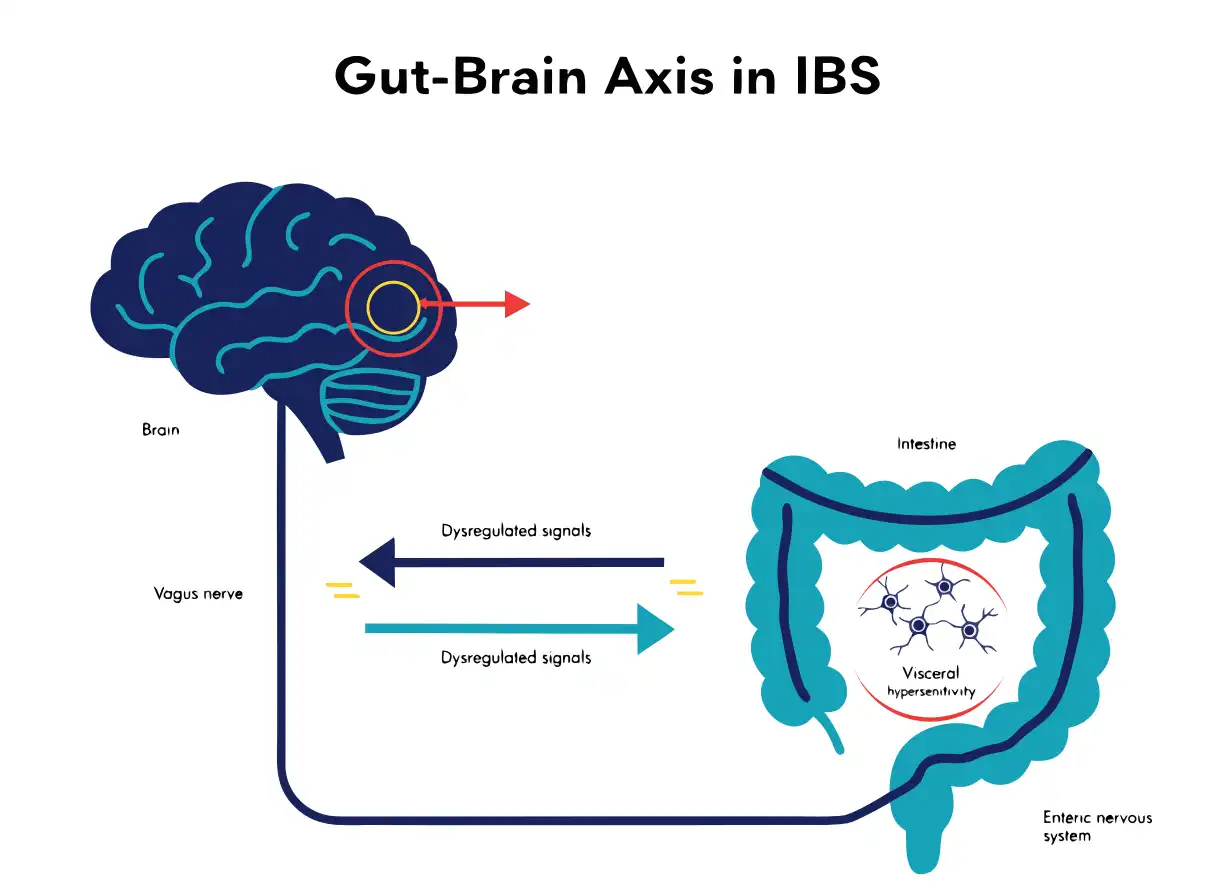 سندرم روده تحریکپذیر (IBS)؛ علائم، انواع و مدیریت سندرم روده تحریکپذیر (IBS)؛ علائم، انواع و مدیریت